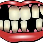 Dream About Losing Teeth – 5 Meanings To It